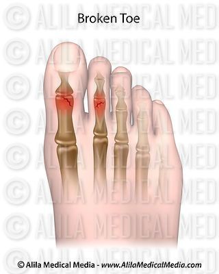 Alila Medical Media | Bones, Joints and Muscles Images