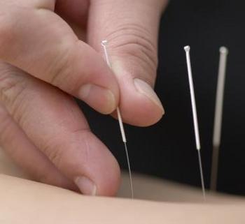 Acupuncture Chelsea Fulham