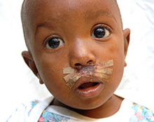 Cleft Lip and Palates