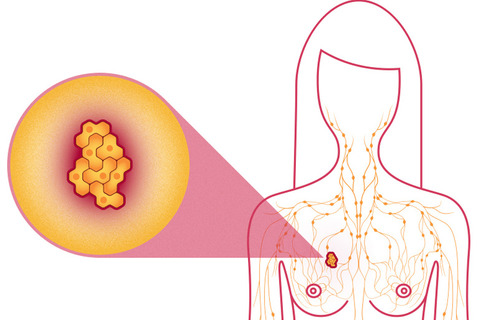 breast description cancer of