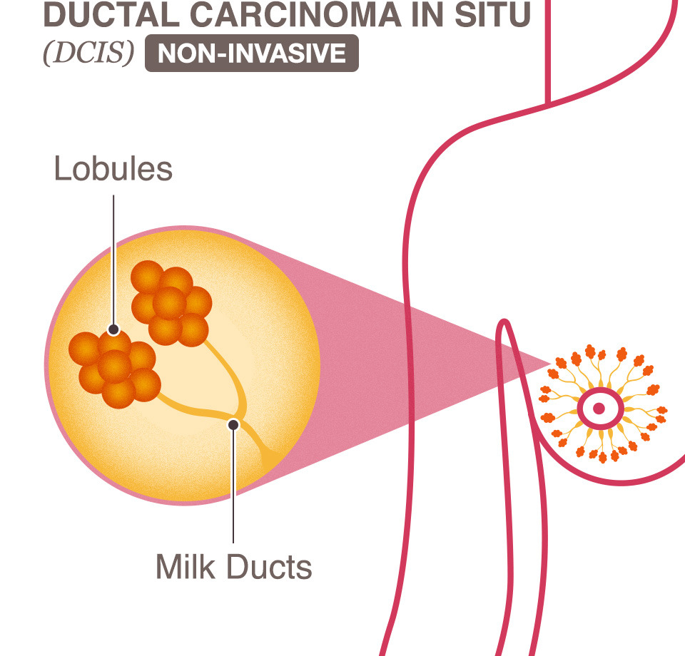 New Technique Identifies Ductal Carcinoma In Situ, Breast