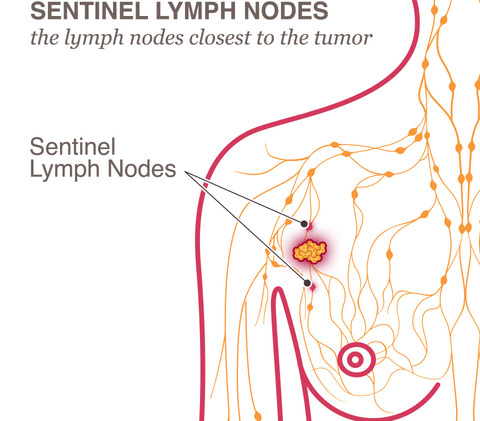 Axillary Lymph Nodes Enlargement Pregnancy Diet