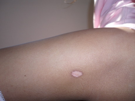 What is this skin problem thing?