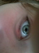 pinkeye
