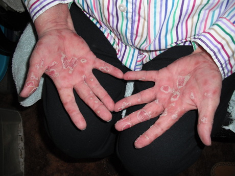 Super Itchy Rash