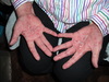 Super Itchy Rash