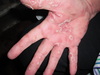 Super Itchy Rash