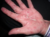 Super Itchy Rash