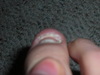Toenail fell off.