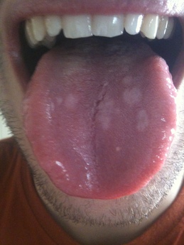 Spotted tongue