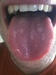 Spotted tongue
