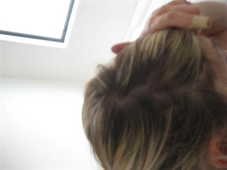 Hair Problems