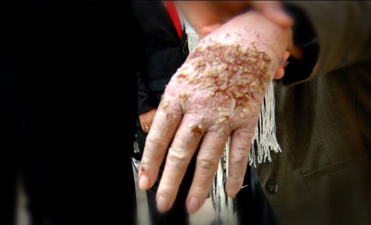 Mulher com feridas graves nas mãos e nos pés é curada