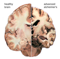 Brain_alzheimer_s_small