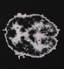 Caption: PET scan from a former opioid addict under the influence of morphine, circa 1980., Credit: Image courtesy of the National Library of Medicine.