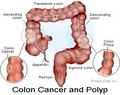 Coloncancer_small