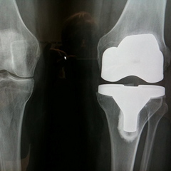 Caption: Titanium Knee Xray, Credit: Walter Murch