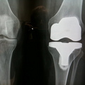 Left_knee_done_small