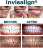 Invisalign_before_after_jefferson_city_mo