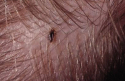 Head Lice Head Lice