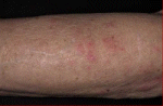Scabies on the arm