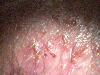 cyst example 2