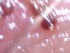 cyst example 3