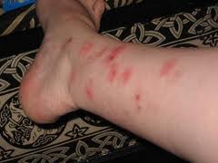 bed bug bites pictures legs