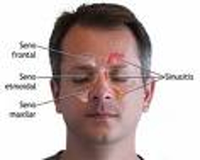 SINUSITIS-TRATAMIENTO CON ULTRASONIDO