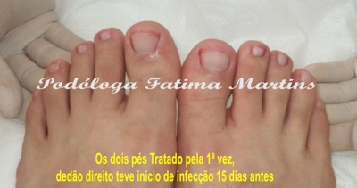 Podóloga- Vc tem unha encravada? Tatuapé - Cangaiba