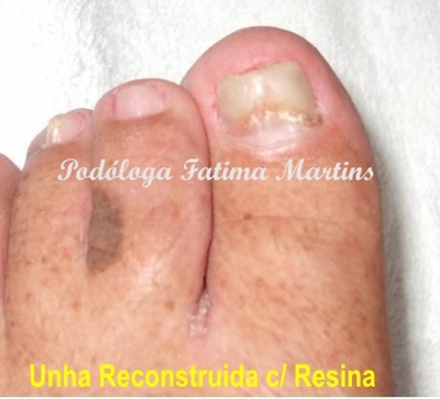 Podóloga-Vc  tem micose nas unhas? Tatuapé - Cangaiba