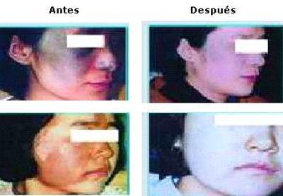 Lasers dermatologico Nd Yag Q-Switched para retirar manchas tatuaje
