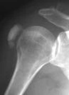 TENDINITIS-TRATAMIENTO CON ULTRASONIDO Y MEDICINA ALTERNATIVA