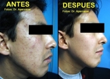 TRATAMIENTO ACNE EN LIMA PERU, POR DERMATOLOGO