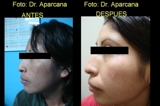 TRATAMIENTO MANCHAS EN LA CARA, MELASMA, DERMATOLOGO EN LIMA PERU