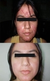Tratamiento para el acne,Elimina el acne