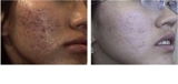 Eliminación de cicatrices, secuelas de acne, huequitos.