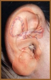 CURSO DE AURICULOTERAPIA (Acupuntura de la Oreja) 