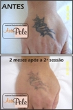 REMOÇÃO DE TATUAGEM