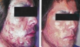 Tratamiento de acne con terapia fotodinamica, dermatologo,lima peru