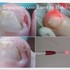 PODOLOGA- TRATAMENTO COM LASER PARA UNHA INFECIONADA - TATUAPÉ e ..