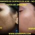Tratamiento cicatrices de acne lima peru por dermatologo