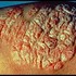 PSORIASIS - dermatologia natural - Dr. J J Fajardo - Lima Peru
