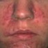 Rosacea - curese definitivamente sin efectos adversos - Homeoderma