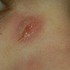 DERMATITIS - Dermatologia natural - HomeoDerma - Dr Fajardo - Lima Metropolitana y Callao - Lima