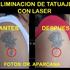 Eliminacion tatuaje con laser por dermatologo lima peru