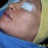 Rosacea - Nuevo metodo - curese  sin efectos adversos - Homeoderma - Lima Metropolitana y Callao - Lima