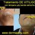 TRATAMIENTO DE VITILIGO EN LIMA PERU POR DERMATOLOGO. DR APARCANA