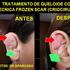 TRATAMIENTO DE QUELOIDES EN LIMA PERU .DERMATOLOGO EN LIMA