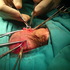 Vaso Vasostomía (Reversión de Vasectomía)